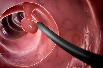Polyp Removal Los Angeles